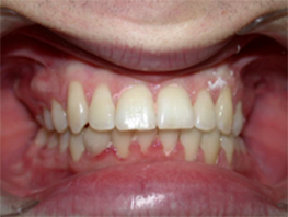 implantes dentales